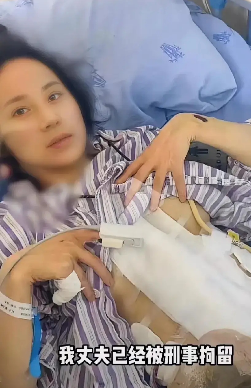 成都美女小谢被丈夫打断肠子,需长期挂粪袋