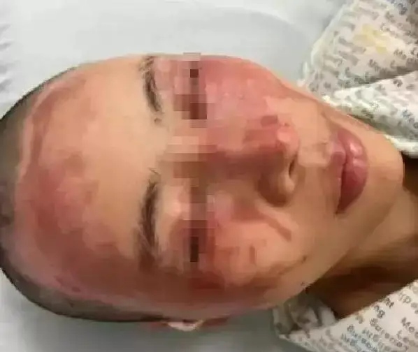 成都美女小谢被丈夫打断肠子,需长期挂粪袋