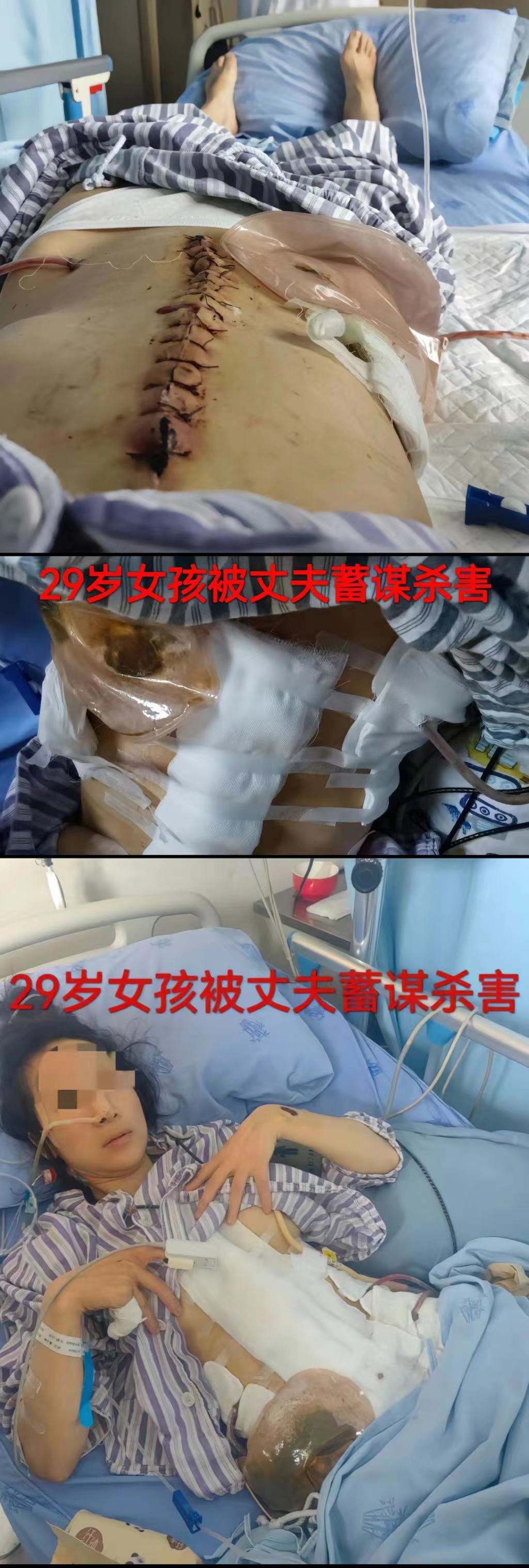 成都美女小谢被丈夫打断肠子,需长期挂粪袋